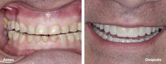Crillas estética dental ourense
