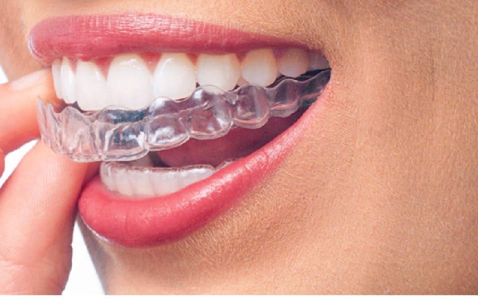 Invisalign, la ortodoncia invisible