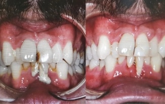 Periodoncia